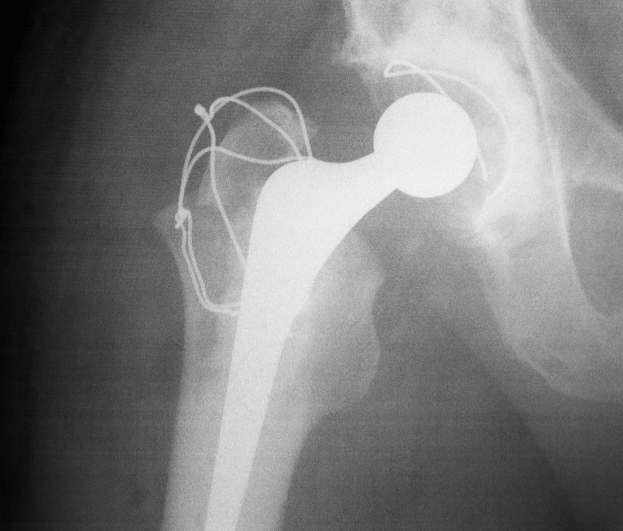 Standard Trochanteric Osteotomy